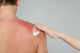 Treatment of sunburn ladylife