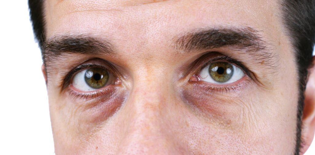 9- Lines around the eyes: